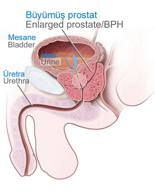 Büyümüş prostat